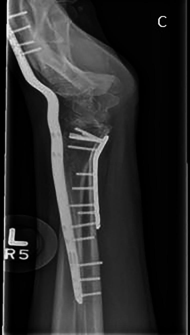 This lateral X-ray radiograph of the left wrist demonstrates post-operative stabilization of a complex distal radius fracture using a dual-plate fixation technique. A volar locking plate is positioned on the anterior aspect of the distal radius, secured with multiple locking screws to maintain articular alignment. Additionally, a long dorsal wrist-spanning plate is visible on the posterior aspect, extending from the radial shaft across the radiocarpal and midcarpal joints to the metacarpals. This spanning hardware acts as an internal fixator to offload the volar fixation and maintain longitudinal traction. The radiograph indicates restored length, rotation, and neutral tilt of the distal radius. The carpal bones, including the lunate and scaphoid, show improved spatial orientation relative to the radial articular surface. This imaging is characteristic of orthopedic management for highly comminuted distal radius fractures or fracture-dislocations where primary volar stability alone is insufficient.