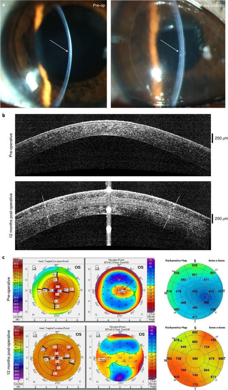 Educational panel illustrating clinical and diagnostic changes following intrastromal implantation of a Bioengineered Porcine Collagen Double Crosslinked (BPCDX) corneal device. Section A shows slit-lamp biomicroscopy photographs comparing the pre-operative thin, steeply curved cornea with the immediate post-operative result (day 1), where central corneal thickness and curvature regularization are visible. Section B features Optical Coherence Tomography (OCT) cross-sectional scans. The 12-month post-operative scan demonstrates sustained corneal thickening, with white arrows delineating the anterior and posterior interfaces of the BPCDX implant within the host stroma. Section C provides longitudinal topographic, elevation, and pachymetric data. The pre-operative maps show high keratometric power (reaching over 60D) and central thinning, characteristic of advanced keratoconus. The 12-month post-operative maps reveal significant flattening (reduction in diopters) and a substantial increase in pachymetric values (central thickness increasing from approximately 420 µm to over 680 µm). The visual provides a comprehensive comparison of surgical outcomes in treating corneal ectasia through bioengineered tissue integration.