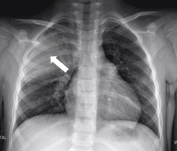 This diagnostic image is a posterior-anterior (PA) chest x-ray of a human patient. The primary finding is a dense, focal area of opacification located in the right upper-to-mid lung zone, indicated by a white arrow. This opacity is characteristic of lobar consolidation, exhibiting relatively well-defined borders and increased radiodensity compared to the more lucent left lung and right lower lung fields. The findings are clinically consistent with right-upper lobe pneumonia. The cardiac silhouette and mediastinal structures appear central and are within normal limits for size and morphology. The costophrenic angles are clear on this view, and the bony structures of the thorax, including the clavicles and ribs, appear intact. This radiological study serves as a classic educational example of community-acquired pneumonia and demonstrates the appearance of alveolar consolidation on plain film radiography.