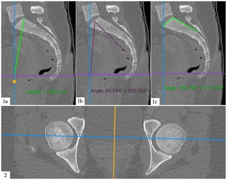 Diagnostic CT scans of the human pelvis and lumbar spine demonstrating lumbopelvic parameters. The image consists of four panels: three sagittal views (1a, 1b, 1c) and one axial view (2). Panel 1a illustrates the measurement of the Pelvic Radius (PR), shown as a green line connecting the posterior-superior corner of the S1 vertebra to the center point between the femoral heads. Panel 1b displays the Pelvic Incidence (PI) angle, formed between a line perpendicular to the sacral plateau and a line connecting the center of the sacral plateau to the midpoint of the femoral heads. Panel 1c shows the Sacral Table Angle (STA), defined by the angle between the posterior wall of the sacrum and the sacral plateau. Panel 2 provides an axial cross-section at the level of the hip joints, showing bilateral femoral heads within the acetabula, with horizontal and vertical reference lines intersecting the centers of rotation to aid spatial orientation and triangulation. These measurements are essential in orthopedic and radiological assessments of spinal sagittal balance and pelvic morphology.