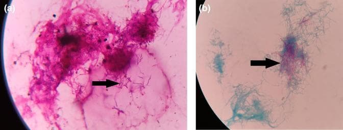 This composite diagnostic image presents two light microscopy views of pleural fluid highlighting the microbiological identification of Nocardia species. Panel (a) shows a Gram stain at high magnification, demonstrating Gram-positive (purple-stained), thin, beaded, and branching filamentous bacteria. Panel (b) illustrates a modified Ziehl-Neelsen (ZN) stain of the same clinical specimen. The bacteria exhibit weak acid-fast properties, characterized by pink-to-red filamentous structures that retain the primary stain against a light blue counterstained background. Arrows in both panels indicate the characteristic filamentous and branching morphology. This combination of Gram-positive branching filaments and partial acid-fastness is a key diagnostic feature used to distinguish Nocardia from other filamentous bacteria like Actinomyces. These findings are clinically significant in diagnosing thoracic nocardiosis in immunocompromised patients or those with pre-existing pulmonary disease.
