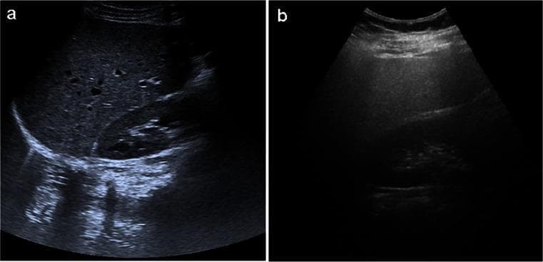 This side-by-side comparison displays two abdominal ultrasound images (B-mode) in the longitudinal plane, illustrating the diagnostic features of nonalcoholic fatty liver disease (NAFLD). Image (a) represents a normal liver, showing a solid, homogeneous echo texture with an echogenicity similar to or slightly higher than the adjacent renal cortex. Vascular structures are well-defined with clear borders, and there is minimal acoustic attenuation, allowing for distinct visualization of deep posterior structures and the diaphragm. Image (b) demonstrates hepatic steatosis (fatty liver). Key diagnostic findings include diffusely increased hepatic echogenicity (the 'bright liver' sign), which creates a significant contrast discrepancy with the renal parenchyma. Furthermore, there is a noticeable blurring of intrahepatic vascular margins and increased acoustic attenuation, resulting in poor visualization of the deeper liver parenchyma and posterior diaphragm. These findings are characteristic of moderate to severe steatosis in the context of NAFLD.