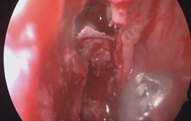 This clinical endoscopic image captures an intraoperative view during a functional endoscopic sinus surgery (FESS), specifically focusing on the right ethmoidal sinus. The visual field demonstrates an antero-posterior ethmoidectomy in progress. Several fractured ethmoidal septations are visible as irregular, whitish bony fragments. The surrounding sinonasal mucosa is notably congested, hyperemic, and edematous, exhibiting a deep red hue consistent with inflammatory changes and surgical trauma. Minimal hemorrhagic and potentially purulent fluid is interspersed among the tissues. In the lower right foreground, a metallic surgical instrument, likely a microdebrider or probe, is positioned to manipulate the bony septa. This image serves as an educational example of intranasal surgical anatomy, demonstrating the controlled breakdown of ethmoidal cells to improve sinus drainage in the context of inflammatory disease or secondary complications like empyema.