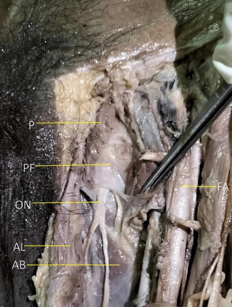 Anatomical dissection of the left anteromedial thigh of a male cadaver, focused on the adductor compartment. The image highlights the spatial relationships of neurovascular and muscular structures following the reflection of the pectineus muscle (P). A prominent anatomical landmark shown is the thick pectineal fascia (PF), which is situated deep to the pectineus and superficial to the emergence of the obturator nerve (ON) main trunk from the obturator foramen. Medial and inferior to the nerve emergence, the adductor longus (AL) and adductor brevis (AB) muscles are visible. Lateral to these structures, the femoral artery (FA) is identifiable. The photograph serves as an educational reference for regional anatomy and surgical approaches to the obturator nerve, emphasizing the pectineal fascia's role as a protective and identifying layer overlying the nerve's division into anterior and posterior branches.