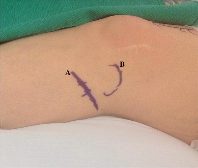 This clinical photograph shows the lateral aspect of a human knee and proximal leg, prepared for a surgical procedure. Purple surgical skin markings delineate key anatomical landmarks for a peroneal nerve decompression. Label 'A' identifies a straight, obliquely oriented line with perpendicular tick marks, indicating the expected course of the common peroneal nerve as it travels posterolaterally and wraps around the fibular neck. Label 'B' shows a curved, semicircular marking outlining the bony prominence of the fibular head. A well-healed, faint linear horizontal scar is visible superior to marking 'B', suggesting prior surgery in the knee region. The image serves as an educational guide for preoperative surface anatomy mapping, specifically for identifying the surgical site and incision path relative to the fibular head and common peroneal nerve to prevent iatrogenic injury and ensure accurate decompression.