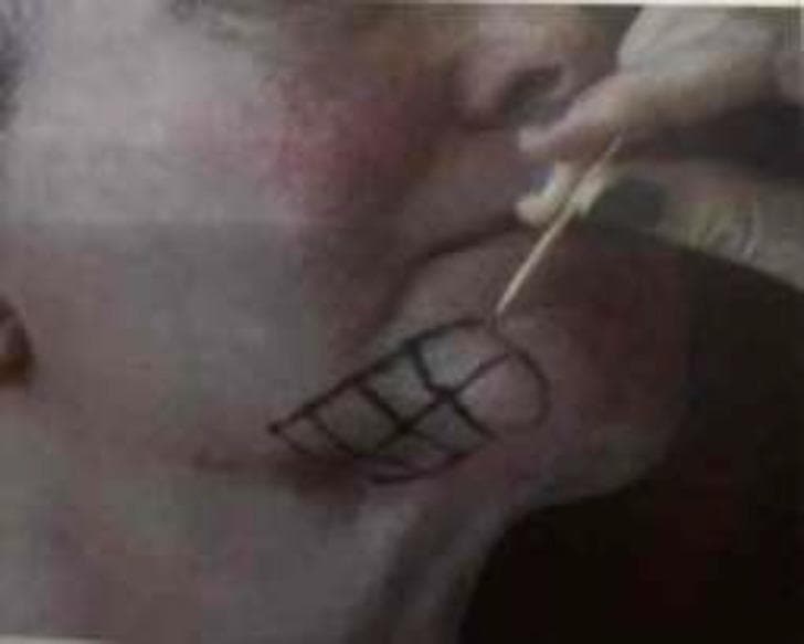This clinical photograph illustrates a medical procedure for trigeminal neuralgia (TN) management. The image displays a close-up of a patient's lower face, specifically the cheek and mandibular region. A hand is seen holding an injection needle, which is being inserted into the skin. A black, hand-drawn grid-like pattern is visible on the surface of the cheek within an oval border, used as a topographical guide for precise intradermal administration. This grid serves to standardize the distribution of the therapeutic agent, identified as incobotulinumtoxin A (Xeomin), at a concentration of 50 units per square centimeter. The visual demonstrates the practical application of botulinum toxin as an interventional pain management technique for neurological facial pain conditions. Key anatomical landmarks include the perioral area, nasolabial fold, and mandible, indicating the target zone for local nerve-related symptom relief.