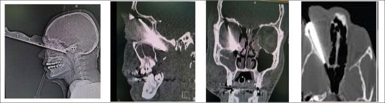 This composite diagnostic image features four Computed Tomography (CT) scans of the head, including a sagittal scout view and axial/coronal cross-sections, demonstrating a penetrating orbital trauma (POT). A large, radiopaque metallic foreign body, identified as a knife blade, is seen entering through the right orbit. The sagittal view illustrates the linear trajectory of the blade extending posteriorly toward the skull base but stopping short of intracranial penetration. The coronal and axial views show the metallic object within the right orbital cavity, causing significant streak artifacts (starburst effect) characteristic of high-density metal on CT. The scans are used to assess the integrity of the superior and inferior orbital rims, maxilla, and zygomatic arch, which appear largely intact. This case illustrates the clinical utility of CT imaging in evaluating the depth and trajectory of penetrating facial injuries, essential for surgical planning and predicting visual prognosis, particularly regarding optic nerve involvement and vascular proximity.
