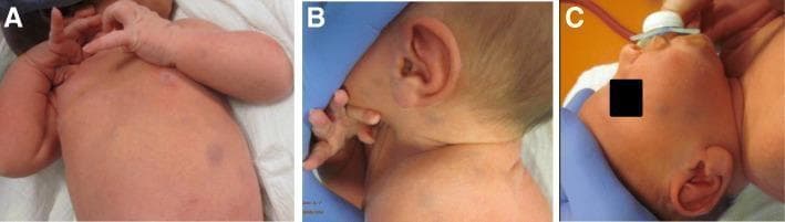 A series of clinical photographs (panels A, B, and C) showing a newborn male with a disseminated 'blueberry muffin' skin rash. Panel A demonstrates multiple oval and circular macules and papules on the trunk and chest, ranging in color from faint magenta to deep purple-livid. Panels B and C highlight similar lesions on the neck, ear, and facial region. The lesions are approximately 0.5 to 1 cm in diameter, non-blanching, and characteristic of dermal erythropoiesis or infiltrative histiocytic disorders. This visual presentation is a classic clinical sign often associated with TORCH infections (such as rubella or cytomegalovirus) or hematologic/histiocytic conditions. In this specific educational case, the lesions are representative of congenital juvenile xanthogranuloma. The distribution is widespread, involving the face, trunk, and extremities, serving as a primary diagnostic indicator for neonatal skin pathology evaluation.