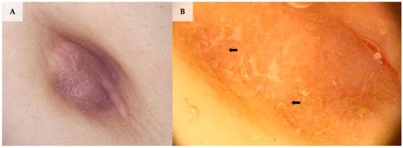 This composite image illustrates the clinical and dermoscopic presentation of umbilical lichen planus. Panel A shows a macro clinical photograph of a well-demarcated, violaceous-to-pink, oval-shaped plaque within the umbilical fold. The surface exhibits characteristic fine white reticular lines (Wickham striae) and a subtle texture suggestive of surface scale. Panel B provides a dermoscopic view (20x magnification) highlighting diagnostic features: a brown structureless background interspersed with prominent white intersecting lines (Wickham striae, indicated by black arrows), white surface scale, and fine coiled (glomerular) vessels. These findings are hallmarks of lichen planus and aid in differentiating this inflammatory dermatosis from other umbilical pathologies like melanoma or seborrheic keratosis. The visual serves as an educational tool for dermatological diagnosis and dermoscopy training, focusing on the identification of specific vascular and structural patterns in inflammatory skin disease.