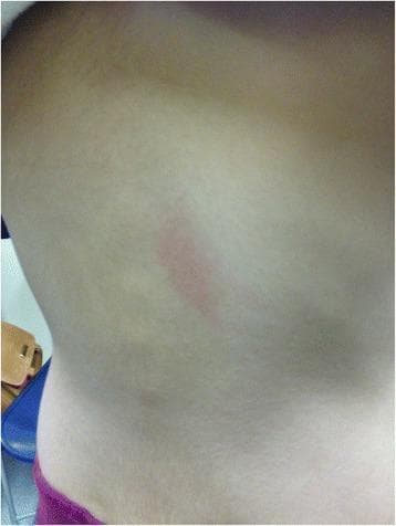 This clinical photograph displays a focal skin lesion on the mid-back of a pediatric patient. The primary finding is a single, vertically-oriented, erythematous plaque or wheal. The lesion is characterized by distinct borders, central redness, and a slightly raised morphology relative to the surrounding healthy skin, which appears otherwise smooth and normochromic. This clinical presentation is characteristic of urticaria (hives), specifically an immediate hypersensitivity reaction. The image demonstrates a localized cutaneous manifestation of a Type I allergic reaction, which in this clinical context occurred 20 minutes following an oral challenge with amoxicillin. This visual serves as an educational example of drug-induced immediate-type allergy in pediatric dermatology and immunology, highlighting the characteristic appearance of a positive oral provocation test result.