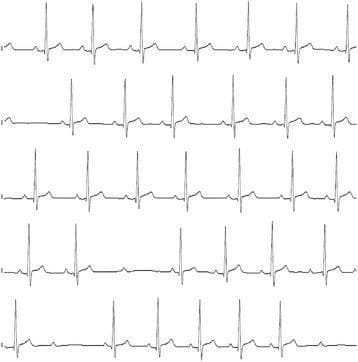 This diagnostic image consists of five continuous electrocardiogram (ECG) rhythm strips demonstrating a second-degree atrioventricular (AV) block, specifically Mobitz Type II. The strips show a regular sinus rhythm with normal P-wave morphology. The PR interval remains constant for conducted beats; however, there are intermittent, non-conducted P-waves (dropped QRS complexes) that occur without prior PR interval lengthening, which is characteristic of Mobitz Type II block. In several sections, the rhythm displays a 2:1 conduction pattern. The QRS complexes appear narrow, suggesting the site of the block is likely at the level of the Bundle of His. This finding is clinically significant as it represents a failure of conduction below the AV node and can progress to complete heart block. In this specific educational context, the arrhythmia is associated with a severe hypothyroid state and bradycardia.