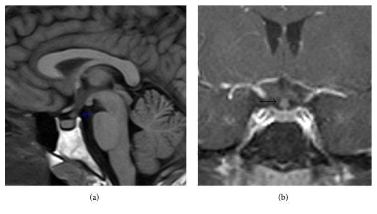 Diagnostic Magnetic Resonance Imaging (MRI) of the brain focusing on the sella turcica and pituitary region. Figure (a) is a sagittal T1-weighted image demonstrating a thickened pituitary stalk (infundibulum), indicated by a blue arrow. Notably, there is an absence of the normal T1-weighted hyperintense 'bright spot' of the posterior pituitary gland (neurohypophysis). Figure (b) provides a coronal T1-weighted view with gadolinium contrast enhancement, further highlighting the nodular thickening and pathological enhancement of the pituitary stalk (black arrow). Surrounding anatomical structures including the anterior pituitary, optic chiasm, sphenoid sinus, and cavernous sinuses are visible. These visual findings are characteristic of infundibuloneurohypophysitis, often associated with systemic conditions such as Langerhans cell histiocytosis, and frequently correlate with clinical symptoms of central diabetes insipidus.