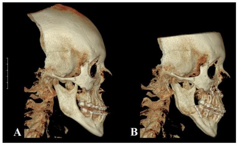 This diagnostic image displays a comparison of two 3D-reconstructed Cone Beam Computed Tomography (CBCT) scans of a human skull in a profile (lateral) view, illustrating the surgical correction of skeletal Class III malocclusion. Image A (pre-surgical) shows significant mandibular protrusion (prognathism) relative to the maxilla, resulting in a concave facial profile and reversed incisor overjet. Image B (post-surgical) demonstrates the result of bimaxillary orthognathic surgery. Specifically, it shows the outcome of a Le Fort I osteotomy used to advance the maxilla and a Bilateral Sagittal Split Osteotomy (BSSO) used to retrude the mandible. Radiopaque (white) osteosynthesis hardware, including plates and screws, is clearly visible along the osteotomy sites in both the maxilla and the mandibular ramus/body. The post-surgical reconstruction reveals a corrected neutral (orthognathic) profile with improved sagittal alignment of the upper and lower jaws and restored dental occlusion.