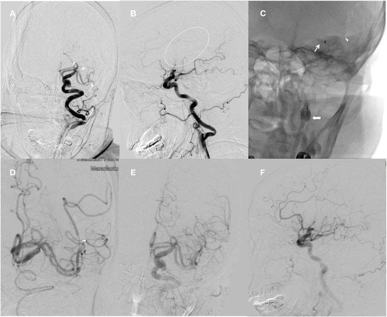 This composite of six digital subtraction angiography (DSA) and fluoroscopic images illustrates a mechanical thrombectomy procedure for acute ischemic stroke. Panels A (anteroposterior) and B (lateral) show the pre-intervention state with proximal occlusions in the left A1 segment of the anterior cerebral artery (ACA), the superior M1 proximal branch, and the inferior Sylvian M2 branch of the middle cerebral artery (MCA), characterized by an abrupt cutoff of contrast flow. Panels C and D demonstrate the intra-procedural combined technique using a balloon guide catheter (BGC), a distal access catheter (DAC), and a stent retriever. The BGC balloon is visibly inflated in the internal carotid artery (ICA) to arrest antegrade flow, while the stent retriever is deployed across the occluded segments. Panels E and F provide the post-intervention angiographic results, showing successful recanalization of the ACA and MCA territories with restored distal perfusion. The series demonstrates the endovascular management of complex intracranial arterial occlusions using modern aspiration and stent-retriever techniques.