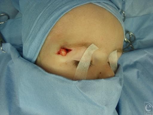 This intraoperative clinical photograph captures the surgical excision of a dermoid cyst in a pediatric patient. The image shows the periorbital region, specifically the lateral aspect of the left eyebrow, where a horizontal incision has been made. Protruding through the surgical opening is a well-circumscribed, spherical, yellowish-white cystic mass, typical of a dermoid cyst containing keratin and sebaceous material. The surrounding skin is clean and shows minimal erythema at the incision margins. The patient is prepared in a sterile field with blue surgical drapes, and the eyes are secured with protective adhesive tape. Surgical instruments are visible in the periphery, indicating an active operative procedure. This visual serves as an educational example of the anatomical presentation and surgical management of common benign head and neck neoplasms in children, highlighting the superficial location and distinct morphology of the cyst relative to local tissues.