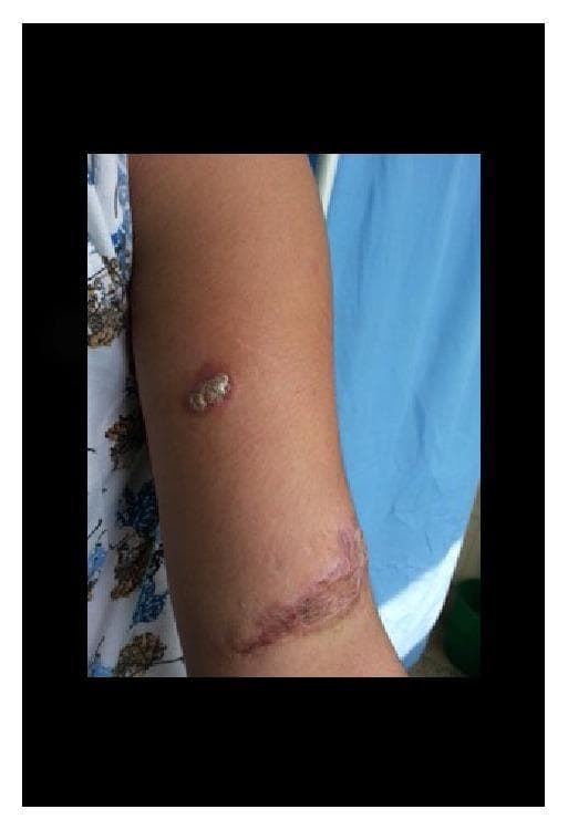 Clinical photograph of the right forearm of a 17-year-old female showing two distinct dermatological findings. The superior lesion is a 2x1 cm erythematous plaque characteristic of lupus vulgaris (cutaneous tuberculosis). This plaque features irregular, slightly raised borders and a central surface with grayish-white scaling or verrucous texture. Distally, on the lower forearm near the antecubital fossa, there is a secondary 4x2 cm linear hypertrophic scar resulting from previous trauma. The scar exhibits hyperpigmentation, irregular texture, and slight elevation. This image serves as a clinical example of cutaneous tuberculosis arising in a patient with a history of local skin injury, illustrating the chronic inflammatory presentation of lupus vulgaris and its morphological distinction from adjacent cicatricial tissue.