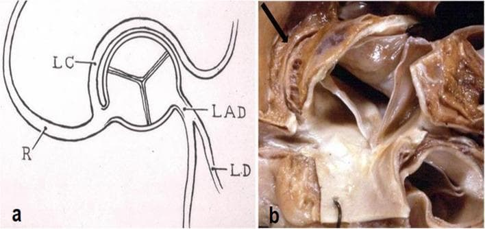 This composite educational material demonstrates a common coronary artery anomaly: the origin of the left circumflex artery from the right coronary artery with a retroaortic course. Panel (a) is an anatomical diagram showing the right coronary artery (R) giving rise to the left circumflex (LC), which then travels posterior to the aortic root. The left anterior descending (LAD) and left descending (LD) arteries are shown originating separately from the left aortic sinus. Panel (b) is a gross clinical photograph of an autopsied aortic root. An arrow points to the actual anomalous vessel as it courses behind the posterior aspect of the aorta. This visual highlights a significant anatomical variation where the LC does not arise from the left main coronary artery but instead originates from the right system and traverses between the aorta and the atria. This condition is clinically relevant in cardiology and cardiothoracic surgery, as the retroaortic pathway can be associated with myocardial ischemia or complicate surgical procedures involving the aortic valve or root.