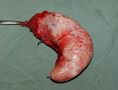 This clinical photograph shows a gross surgical specimen of an appendiceal mucocele, presented in a lateral view against a green surgical drape. The specimen is an oblong, distended, comma-shaped cystic mass approximately 15 cm in length. The surface is predominantly pearly white and glistening, indicative of a stretched serosal layer, with diffuse areas of erythema and prominent superficial vascularization. There are focal subserosal hemorrhages or petechiae visible across the curved body of the appendix. At the proximal end (the base), the tissue is intensely congested and hemorrhagic, showing the site of surgical excision where a metallic surgical instrument and a dark suture are visible. The specimen demonstrates the characteristic macroscopic appearance of a mucinous cystadenoma of the appendix, illustrating the significant luminal dilation caused by intraluminal mucin accumulation. This image is relevant for surgical pathology and gastroenterology education, specifically regarding the diagnosis and surgical management of appendiceal neoplasms.