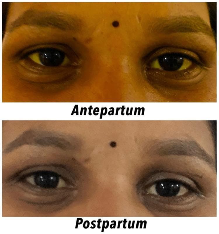 This clinical photograph provides a side-by-side comparison of facial features in a female patient, illustrating the resolution of icterus (jaundice) from the antepartum to the postpartum period. The top panel, labeled 'Antepartum,' displays bilateral scleral icterus, characterized by a distinct yellow discoloration of the ocular sclera. Additionally, the periorbital and facial skin exhibits a generalized yellowish hue. The bottom panel, labeled 'Postpartum,' shows the same patient after delivery, demonstrating a significant clinical improvement. The sclerae have returned to a normal white color, and the skin tone has transitioned back to a typical pigmentation, indicating a reduction in serum bilirubin levels. This comparison is used to visualize the clinical manifestation and subsequent resolution of hepatobiliary or hemolytic conditions during pregnancy, such as intrahepatic cholestasis of pregnancy (IHCP) or other pregnancy-related liver disorders. The image serves as an educational tool for identifying physical signs of hyperbilirubinemia and monitoring treatment response in an obstetric context.
