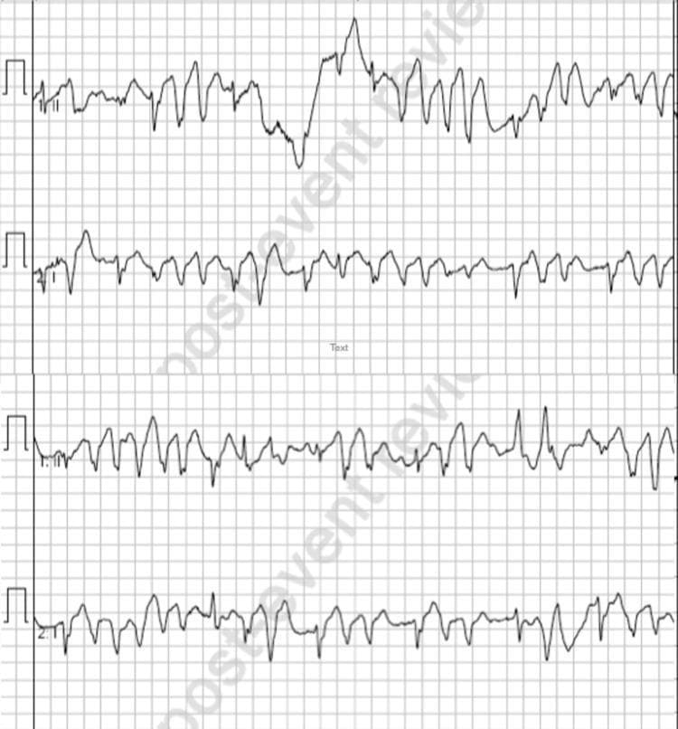 Diagnostic electrocardiogram (ECG) rhythm strips showing an acute cardiac arrhythmia on standard grid paper. The image consists of four consecutive rhythm leads displaying polymorphic ventricular tachycardia (PVT). The tracing is characterized by a rapid, chaotic rhythm with continuously changing QRS complex morphology, amplitude, and axis. There is a complete absence of identifiable P waves and distinct T waves, indicating severe ventricular dysrhythmia. The waveforms show a characteristic 'twisting' or undulating appearance around the isoelectric line, consistent with Torsades de Pointes or similar polymorphic ventricular patterns. This diagnostic image illustrates a critical clinical state that can occur post-adrenaline administration in patients with underlying conduction issues, such as heart block. It serves as an educational example of high-grade ventricular irritability and unstable cardiac rhythms that require immediate medical intervention.