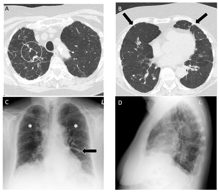 Educational multi-modal imaging of fibrotic hypersensitivity pneumonitis (Farmer's Lung). (A, B) Axial high-resolution computed tomography (HRCT) of the chest demonstrating key interstitial features. Image A shows a peribronchovascular distribution of reticular opacities (white circle) accompanied by mosaic lung attenuation, suggesting small airway involvement. Image B highlights mild diffuse subpleural reticulations (black arrows). (C, D) Posteroanterior and lateral chest radiographs revealing coarse reticulations and interstitial fibrosis (asterisks) primarily concentrated in the upper lung zones, associated with mild volume loss. A surgical staple line (black arrow in C) is visible in the left lower lobe, representing a prior diagnostic biopsy site. The imaging illustrates the classic presentation of chronic occupational interstitial lung disease, characterized by upper-lobe predominant fibrosis and architectural distortion.