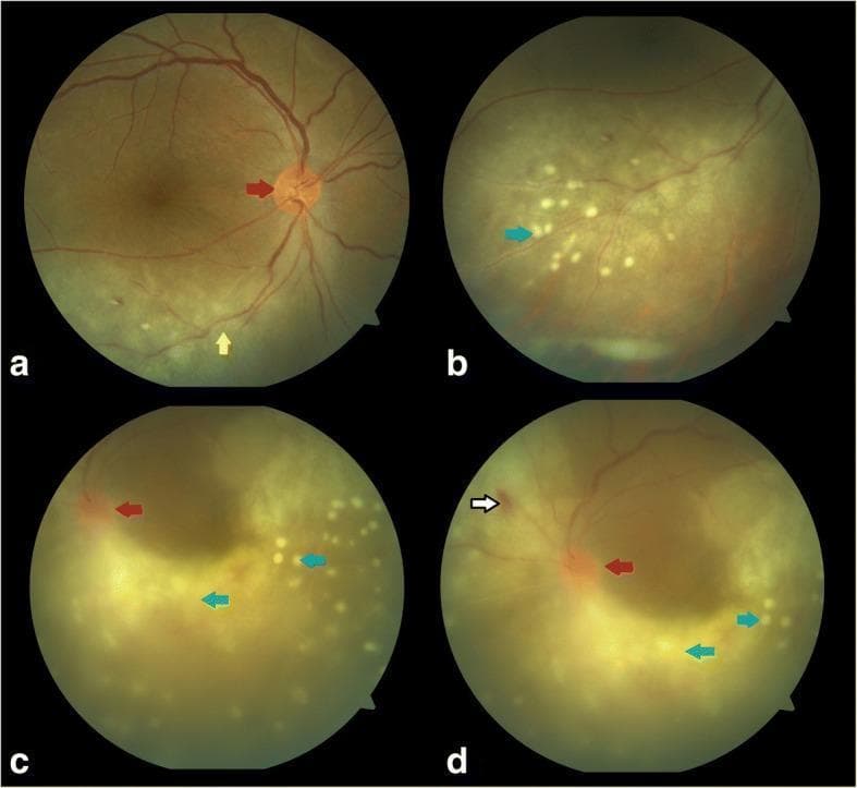 Clinical color fundus photographs of the right (a, b) and left (c, d) eyes demonstrating bilateral ocular syphilis and HIV-related posterior segment inflammation. The right eye (a, b) shows optic disc hyperemia (red arrow) and a widespread area of ground-glass retinochoroiditis (yellow arrow) in the inferior retina. Higher magnification (b) reveals numerous small, discrete, cream-colored superficial retinal precipitates (blue arrows) along the inferotemporal arcade, characteristic of acute syphilitic posterior placoid chorioretinitis. The left eye (c, d) demonstrates more severe inflammation with dense vitritis (green arrow) causing significant haze. Notable findings include a hyperemic optic disc (red arrow), a focal intraretinal hemorrhage superonasal to the disc (white arrow), and scattered superficial retinal precipitates (blue arrows) throughout the posterior pole. The images illustrate key diagnostic features of syphilitic uveitis and retinitis in the context of immunocompromise, highlighting the variation in severity and morphology between eyes, including placoid lesions, vitritis, and multifocal inflammatory precipitates.