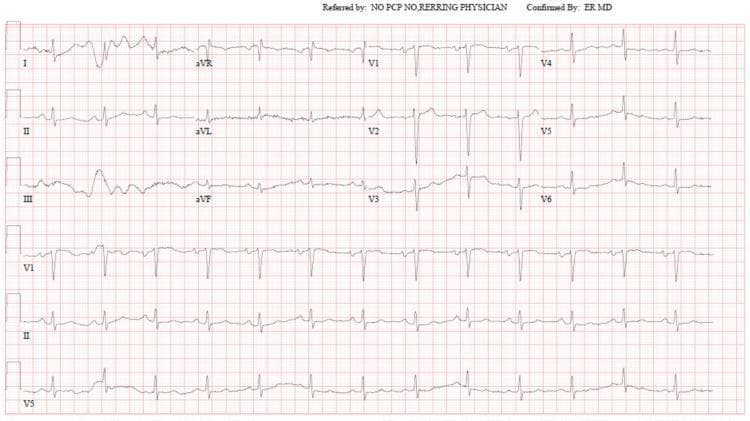 This diagnostic image is a standard 12-lead electrocardiogram (ECG) displayed on a red grid background. The tracing includes the limb leads (I, II, III, aVR, aVL, aVF) and precordial leads (V1-V6), along with rhythm strips for V1, II, and V5 at the bottom. The rhythm demonstrates a normal sinus rhythm with clearly visible, upright P waves in leads I, II, and V4-V6. The QRS complexes are narrow, and there is a normal R-wave progression from V1 through V6. The ST segments are isoelectric, and the T waves are largely upright, showing no acute signs of ischemia, infarction, or the classic manifestations of hyperkalemia (such as peaked T waves or widened QRS complexes). This ECG serves as a clinical example of a 'normal' tracing in a patient with pseudo-hyperkalemia, illustrating the absence of cardiac electrophysiological changes despite laboratory reports of severely elevated serum potassium levels. It is an important educational tool for medical professionals to differentiate between true electrolyte-induced cardiac emergencies and laboratory artifacts in the context of hematologic malignancies like chronic lymphocytic leukemia.
