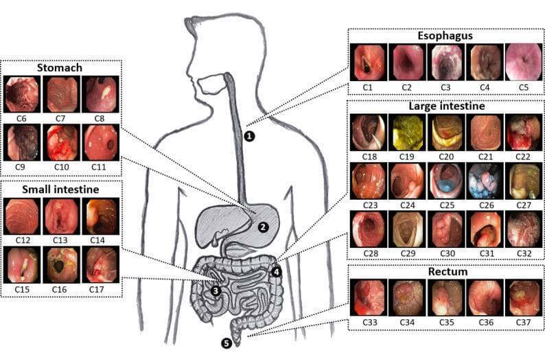 An educational anatomical diagram and infographic illustrating the human gastrointestinal (GI) tract and corresponding endoscopic findings. Centered is a line drawing of a human torso showing the digestive system with numbered regions: 1 (Esophagus), 2 (Stomach), 3 (Small Intestine), 4 (Large Intestine), and 5 (Rectum). Surrounding this central figure are five categorized panels containing 37 endoscopic image frames (C1-C37). The Esophagus panel (C1-C5) shows variations in luminal appearance and mucosal texture. The Stomach panel (C6-C11) displays clinical signs such as dark necrotic patches, erythematous lesions, and possible blood clots. The Small Intestine panel (C12-C17) illustrates healthy pinkish mucosa alongside abnormalities like stenotic lesions and discoloration. The Large Intestine panel (C18-C32) is the most extensive, showing a spectrum of pathologies including polyps, inflammatory changes, and varied fecal matter. The Rectum panel (C33-C37) depicts distal GI findings including nodular tissue and masses. The graphic serves to classify endoscopic data by anatomical district, demonstrating high intraclass variance and various disease manifestations suitable for medical AI training and gastroenterology education.