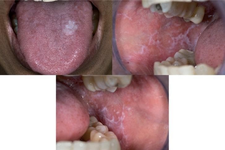 A composite of three clinical photographs showing intraoral manifestations of Oral Lichen Planus. The top-left image displays a well-demarcated, irregularly shaped white plaque (plaque-type lichen planus) on the right dorsum of the tongue, which clinically resembles leukoplakia or hyperplastic candidiasis. The top-right and bottom images show the bilateral buccal mucosa, highlighting classic reticular lichen planus characterized by a network of fine, white, interconnected lacy lines known as Wickham striae. These striae appear against a background of erythematous (pinkish-red) mucosa. The presence of these reticular lesions elsewhere in the oral cavity assists in the differential diagnosis of the isolated lingual plaque. This educational visual demonstrates common diagnostic challenges in oral medicine, specifically the distinction between plaque-type lichen planus, leukoplakia, and lichenoid reactions.