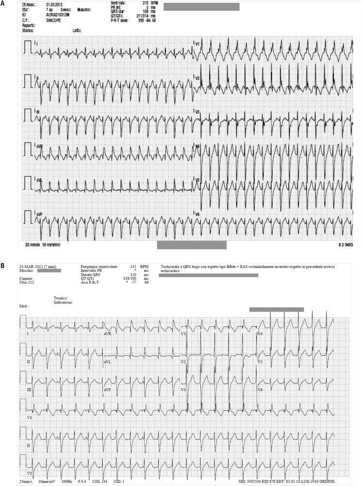 Two diagnostic 12-lead electrocardiogram (ECG) tracings (labeled A and B) from a 7-year-old male patient showing wide-complex tachyarrhythmias. Figure 1A demonstrates a regular, wide QRS tachycardia at a rate of approximately 215 BPM. The morphology exhibits features consistent with a right bundle branch block (RBBB) pattern and a superior axis, suggestive of left anterior fascicular block. Figure 1B shows a subsequent episode of wide-complex tachycardia at a slower rate of 132 BPM, maintaining the RBBB-like morphology and superior QRS axis deviation. Key diagnostic parameters provided in the ECG headers include a QRS duration of 110 ms in Figure 1B and a markedly shifted P-R-T axis between the two recordings. Both tracings represent ventricular fascicular tachycardia (VFT), a specific type of idiopathic ventricular tachycardia often characterized by a RBBB pattern and axis deviation. The images serve as educational materials for distinguishing fascicular ventricular tachycardia from other forms of supraventricular or ventricular arrhythmias based on QRS morphology, axis, and rate.