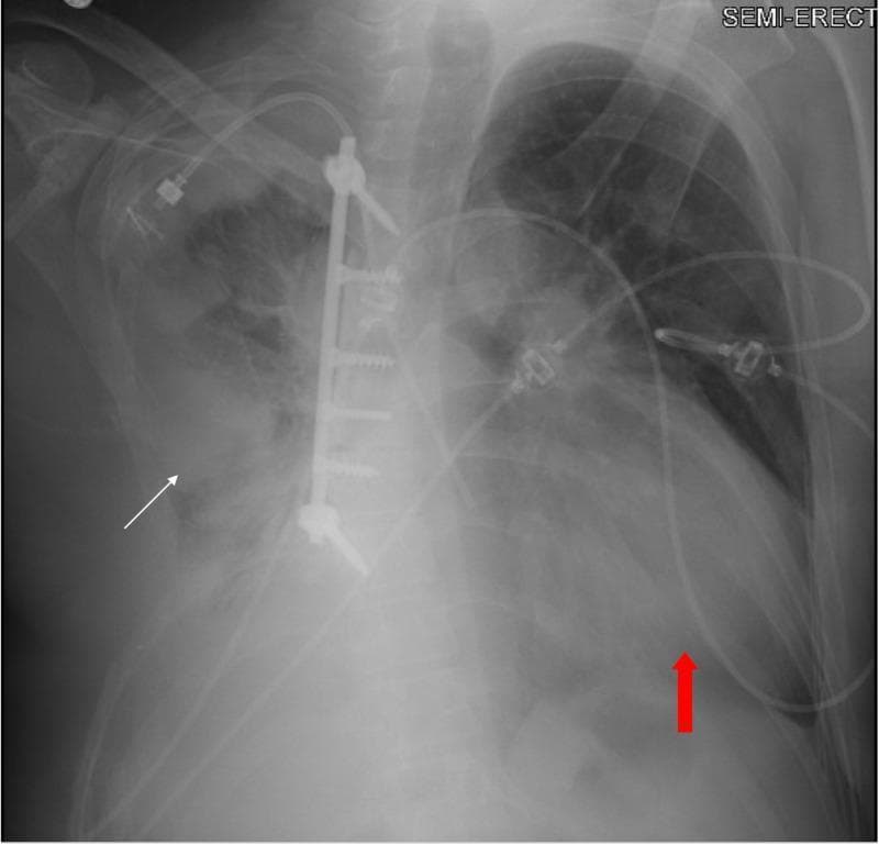This diagnostic image is a semi-erect anteroposterior (AP) chest radiograph. The image displays a significantly enlarged cardiac silhouette (red arrow), suggesting global cardiomegaly or a large pericardial effusion, which contributes to an increased cardiothoracic ratio. In the right hemithorax, findings are consistent with status post-chest wall resection, featuring a vertical metallic fixation plate and screws along the thoracic wall. Adjacent to this surgical site, there is a dense, irregular area of increased opacity in the right mid-to-lower lung field (white arrow), representative of a remnant or recurrent neoplastic process. Multiple medical devices are visible, including ECG leads and tubing across the precordium. This radiograph illustrates complex post-surgical thoracic anatomy combined with progressive oncological and cardiovascular complications, such as metastatic spread and potential pericardial tamponade physiology.