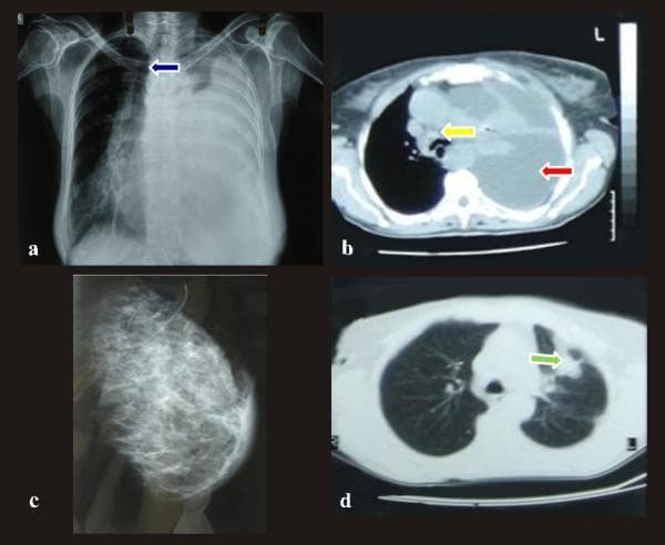 This composite of clinical imaging illustrates diagnostic findings in a case of primary lung adenocarcinoma with breast metastasis. (a) Anteroposterior chest x-ray reveals a massive left-sided pleural effusion causing near-complete opacification of the left hemithorax and a significant mediastinal shift toward the right (blue arrow). (b) Axial chest CT scan (mediastinal window) shows a massive pleural effusion (red arrow) resulting in compressive atelectasis of the left lung and severe contralateral displacement of the trachea and mediastinum; paratracheal lymphadenopathy is also noted (yellow arrow). (c) Digital mammography of the left breast demonstrates a diffuse, asymmetrical density in the subareolar and upper outer quadrant without discrete margins or microcalcifications, suggesting inflammatory or metastatic infiltration. (d) Axial chest CT (lung window) highlights a 3.5 x 4.5 cm irregular peripheral lesion in the left upper lobe (green arrow) with spiculation and extension into the surrounding parenchyma, making contact with the pleura. These images collectively demonstrate the radiological presentation of metastatic lung cancer involving the pleura and breast.