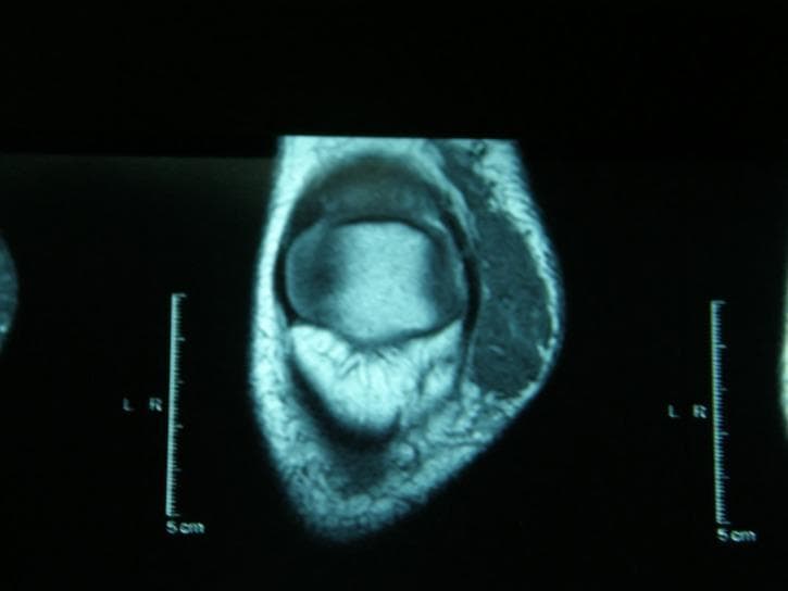 This diagnostic image is an axial magnetic resonance imaging (MRI) scan of the right knee joint. The cross-section clearly demonstrates the bony anatomy, including the distal femoral metaphysis or proximal tibia, characterized by a well-defined cortical rim and internal cancellous bone signal. Surrounding soft tissue structures are visible, with varying signal intensities distinguishing muscle groups, subcutaneous fat, and connective tissues. A 5 cm scale is provided on both the left and right sides of the image frame for anatomical measurement. This imaging modality is essential for evaluating intra-articular pathologies such as meniscal tears, ligamentous injuries (ACL/PCL), and osteochondral defects. The scan utilizes a standard clinical gray-scale display to represent tissue density and proton distribution, serving as a primary tool for musculoskeletal radiology education and orthopedic diagnostic planning.