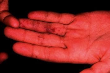 This clinical photograph displays the palmar surface of a hand and fingers, highlighting classic dermatological manifestations of Janeway lesions. The image shows multiple, small, non-tender, erythematous macular rashes and hemorrhagic spots. These lesions are primarily distributed along the distal aspects of the fingers, specifically on the tips and pads. Morphologically, the lesions appear as flat, irregular, reddish-purple spots that do not involve significant skin elevation or surrounding edema. Clinically, these findings are pathognomonic for infective endocarditis, representing septic microemboli that lead to vascular injury and subcutaneous hemorrhage. The surrounding skin texture remains otherwise unremarkable, lacking signs of scaling or diffuse inflammation. This visual is an essential educational tool for identifying peripheral stigmata of systemic infection and differentiating painless Janeway lesions from painful, raised Osler nodules.