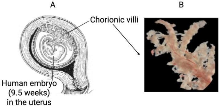 The image consists of two panels illustrating human chorionic villi. Panel A is an anatomical diagram in sagittal cross-section showing a pregnant uterus with a human embryo at approximately 9.5 weeks of gestation. The diagram highlights the spatial relationship of the gestational sac, the developing embryo, and the chorionic villi, which are concentrated at the embryonic pole (chorion frondosum) where the placenta is forming. Panel B is a high-resolution macroscopic clinical photograph of an isolated chorionic villus specimen against a dark background. The specimen exhibits a characteristic arborizing or branching morphology, resembling frond-like or tree-like structures. It appears pale cream to off-white in color, with visible fine reddish-pink vascular traces running through the core of the larger branches. This comparison demonstrates the in situ anatomical orientation of the villi versus their complex, branched physical structure, which is optimized for surface area expansion to facilitate maternal-fetal nutrient and gas exchange. The content is highly relevant to embryology, obstetrics, and prenatal diagnostic procedures such as chorionic villus sampling (CVS).
