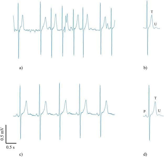 This Comparison Chart illustrates electrocardiography (ECG) waveforms in a single patient during both atrial fibrillation (AF) and sinus rhythm (SR). (a) A 5-second ECG strip showing AF characterized by an irregularly irregular rhythm, absent P waves, and fine fibrillatory oscillations of the baseline. (b) An extracted average beat from the AF strip, revealing a clear T wave and a subsequent U wave that was previously obscured by fibrillatory noise. (c) A 5-second ECG strip showing SR with a regular rhythm, identifiable P waves preceding each QRS complex, and visible U waves. (d) An extracted average beat from the SR strip showing clear P, T, and U wave morphologies. The comparison demonstrates that U waves maintain similar morphology across both rhythms, though they are often indistinguishable in raw AF recordings without signal processing. Scale bars indicate 0.5 mV and 0.5 s. This image is relevant for cardiology students and clinicians studying ventricular repolarization and advanced ECG signal analysis.