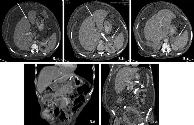 This series of axial and coronal contrast-enhanced computed tomography (CECT) images demonstrates various patterns of peritoneal carcinomatosis involving abdominal ligaments and fissures. The imaging highlights metastatic soft tissue deposits in several key anatomical sites:
1. Perihepatic ligaments: Axial scans (3.a, 3.b) show heterogeneously enhancing soft tissue nodules along the falciform ligament/ligamentum teres (thin white arrows) and the ligamentum venosum (thick white arrow in 3.b).
2. Lesser Omentum: Coronal images (3.d) reveal enhancing deposits in the gastrohepatic ligament (curved arrow) situated between the left hepatic lobe and the lesser curvature of the stomach.
3. Hepatoduodenal Ligament: A coronal section (3.e) displays an ill-defined soft tissue mass extending along the portal vein toward the porta hepatis (white arrowhead).
4. Gastrosplenic Ligament: Axial views (3.b, 3.c) identify deposits between the greater curvature of the stomach and the spleen (dotted arrows).
The images collectively illustrate how peritoneal fluid stasis and anatomical conduits facilitate the spread of malignancies like ovarian and breast carcinoma to the ligamentous recesses of the abdominal cavity.
