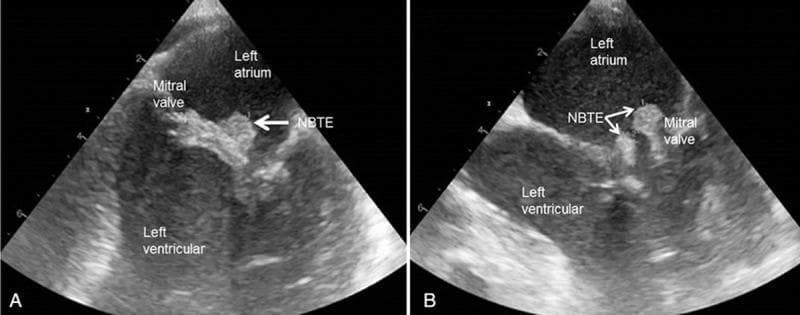 This diagnostic image consists of two panels (A and B) showing transesophageal echocardiography (TEE) in a long-axis view. The images depict the left atrium, left ventricle, and the separating mitral valve. In both panels, prominent sterile vegetations characteristic of nonbacterial thrombotic endocarditis (NBTE), also known as Marantic endocarditis, are visible as highly echogenic masses attached to the mitral valve leaflets. These vegetations protrude into the left atrial space. Panel A displays a single large irregular vegetation, while Panel B reveals the fragmented or multi-lobulated nature of the thrombi. The clinical context involves a patient with pancreatic cancer, illustrating a paraneoplastic manifestation of malignancy-associated hypercoagulability. This image is used to teach the identification of embolic sources in patients with cancer-related ischemic stroke and highlights the importance of TEE in diagnosing valvular vegetations that may be missed on transthoracic echocardiography.