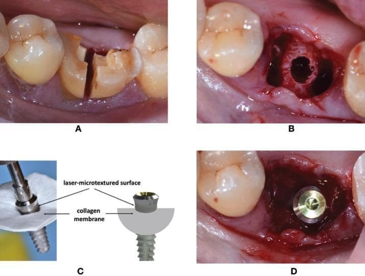 A series of four images (A-D) documenting an immediate dental implant procedure in a mandibular molar site. Figure A shows the clinical photograph of a mandibular molar tooth sectioned mesiodistally to facilitate atraumatic extraction. Figure B displays the post-extraction socket with the inter-radicular recipient site surgically prepared. Figure C features a photograph and corresponding diagram showing the assembly of a dental implant and a resorbable collagen membrane; the implant is inserted through the membrane such that the laser-microtextured collar remains coronal to the membrane. Figure D illustrates the clinical placement of the implant-membrane complex into the socket, showing the implant centrally positioned with the membrane tucked under the peripheral soft tissue margins. This sequence demonstrates a Guided Bone Regeneration (GBR) technique specifically using a laser-microtextured implant surface to promote soft tissue sealing while utilizing the membrane to manage alveolar bone defects during immediate placement.