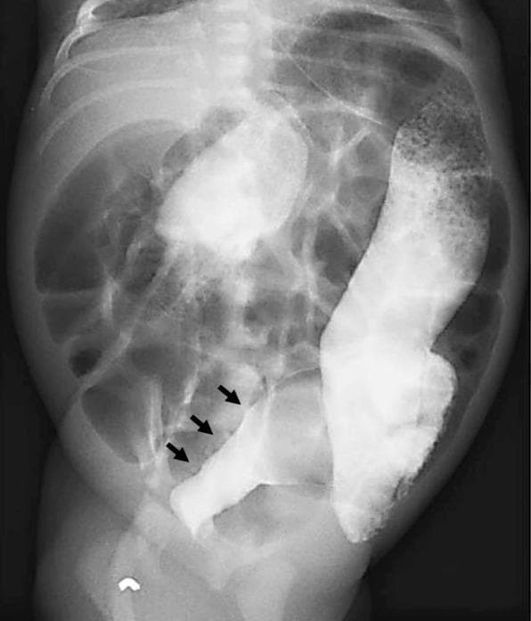 This abdominal contrast enema (fluoroscopy/X-ray radiography) of a neonate illustrates the classic radiological features of Hirschsprung disease. The image demonstrates a clear transition zone in the distal bowel. Specifically, black arrows highlight a narrowed caliber and constricted lumen within the rectosigmoid colon, representing the aganglionic segment. In contrast, the proximal descending colon appears dilated (megacolon) as it attempts to overcome the distal obstruction. The abdominal cavity shows diffuse gaseous distension of bowel loops superior to the pelvic cavity. This diagnostic imaging is used in pediatric gastroenterology to identify a 'rectosigmoid ratio' suggestive of functional obstruction. The clinical context involves a newborn presenting with delayed meconium passage, abdominal distension, and poor feeding, where the transition from a narrow rectum to a dilated proximal colon is the hallmark finding for identifying the transition zone before definitive surgical biopsy.