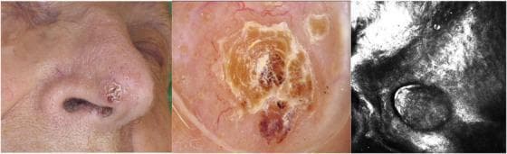 This composite figure illustrates the clinical, dermoscopic, and reflectance confocal microscopy (RCM) findings of a basosquamous carcinoma (BSC) on the nose. Image A (Clinical Photograph) shows an erythematous, squamous nodule located on the nasal tip, characterized by a central hyperkeratotic crust and irregular borders. Image B (Dermoscopy) reveals diagnostic features suggestive of both basal cell and squamous cell lineages: a central white-to-yellow keratin mass, focal blood spots, and peripheral arborizing telangiectasia against a whitish structureless background. Image C (RCM) displays the microscopic architecture at the dermo-epidermal junction, showing dark peritumoral clefts and basaloid islands with peripheral palisading, alongside larger polygonal cells representing atypical keratinocytes. This multimodal imaging comparison highlights the overlapping features of BCC and SCC that define BSC, providing high-resolution visual evidence for the diagnosis of this aggressive non-melanoma skin cancer subtype.