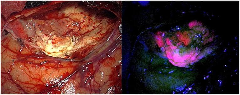 Side-by-side intraoperative microscopic clinical photographs comparing healthy brain parenchyma and glioblastoma under different lighting conditions. The left image, captured under standard white light, demonstrates the surgical field showing cerebral cortex, vascular supply, and a pale, yellowish tumor mass within the resection cavity. This view provides anatomical context but offers limited contrast between tumor margins and healthy tissue. The right image displays the same field using 440 nm blue light excitation for fluorescence-guided surgery (FGS). In this view, areas containing Protoporphyrin IX (PpIX) emit a distinct red-pink fluorescence, while healthy brain tissue remains dark or exhibits low-intensity green/blue autofluorescence. The fluorescent signal is concentrated in the central tumor mass, showing non-uniform distribution and intensity gradients that help surgeons differentiate neoplastic cells from the surrounding parenchyma. This comparison illustrates the clinical utility of 5-ALA induced fluorescence in enhancing real-time tumor visualization and margin detection during neurosurgical procedures.