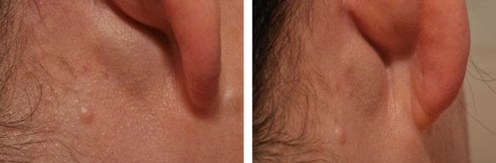 This clinical photograph displays two views of a postauricular swelling behind the right ear of a patient. The left image provides a posterolateral perspective, while the right image offers a direct posterior view. A distinct, rounded mass is visible in the postauricular region, positioned just behind the pinna and below the level of the mastoid. In the posterior view, the swelling is more prominent, causing a noticeable alteration in the natural contour of the neck and ear junction. The overlying skin appears taut and smooth over the peak of the mass, with a slight sheen suggestive of underlying pressure. No significant erythema, ulceration, or acute inflammatory changes are visible on the skin surface. Clinically, such a presentation in the context of pulsatile tinnitus suggests a vascular etiology, such as an arteriovenous malformation or fistula involving the external carotid artery branches and the jugular system.