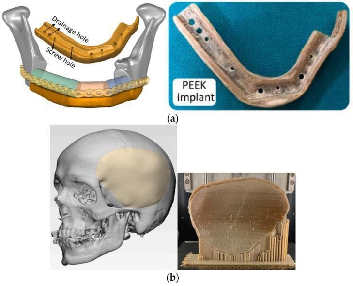 This educational image illustrates the application of 3D-printed polyetheretherketone (PEEK) for patient-specific maxillofacial and cranial implants. Figure (a) displays a mandible reconstruction case, showing a 3D digital schematic alongside a physical PEEK mandible implant. The digital model highlights anatomical positioning relative to the condyles and identifies functional features including 'drainage holes' and 'screw holes.' The physical implant is a tan-colored, U-shaped biocompatible structure with visible circular perforations for drainage and fixation. Figure (b) focuses on neurosurgical reconstruction, featuring a digital skull model with a highlighted left temporal/parietal cranial defect alongside a physical PEEK cranial bone implant. The physical implant is shown post-fabrication on a 3D printing build plate, supported by a vertical lattice-like scaffold. The image demonstrates the use of additive manufacturing to create complex, anatomical geometries for bone replacement in oral and maxillofacial surgery and neurosurgery, emphasizing the transition from virtual design to physical biomedical hardware.