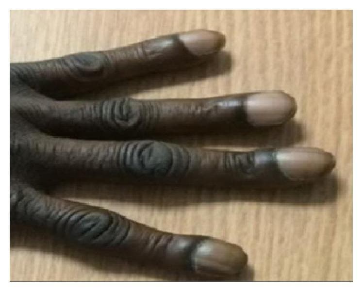 This clinical photograph displays the hand and fingers of a patient with severe digital clubbing, a clinical sign often associated with chronic hypoxia or certain systemic diseases. The image demonstrates characteristic 'drumstick' appearances of the distal phalanges, characterized by bulbous swelling and enlargement of the fingertips. The nails exhibit increased convexity in both the longitudinal and transverse planes, along with a significant increase in the Lovibond angle (the angle between the nail plate and the proximal nail fold). The skin overlying the interphalangeal joints shows marked thickening and deep, horizontal wrinkling, consistent with pachydermoperiostosis (primary hypertrophic osteoarthropathy). These visual findings are diagnostic markers for advanced clubbing (Grade 4). The content is relevant for medical education focusing on physical examination signs, rheumatology, and pulmonology.