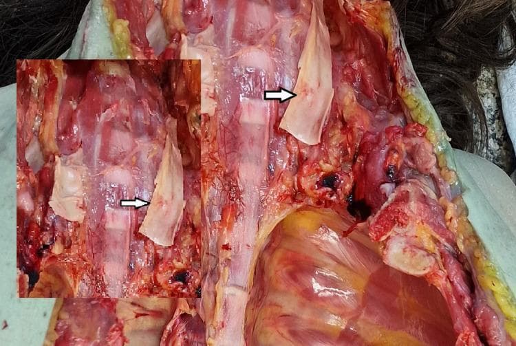 This clinical photograph displays a forensic internal examination of the neck structures, focusing on the carotid artery. The primary image and a smaller inset both use a white arrow to highlight Amussat's sign: a minimal, horizontal, transversal intimal tear located on the inner layer of the left common carotid artery. The artery appears as a pale, tubular structure, while the surrounding strap muscles and soft tissues exhibit deep red discoloration and hemorrhagic staining. This finding is a classic forensic indicator of mechanical neck trauma, often associated with hanging or strangulation, resulting from the sudden stretching of the vessel walls. The visual context includes the dissected neck area, revealing the relationship between the vascular pathology and the surrounding muscular and cartilaginous structures of the throat.