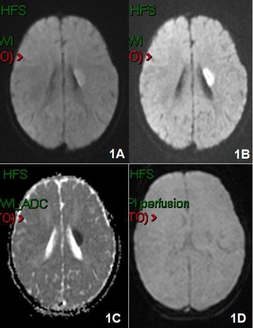 This diagnostic image is a four-panel axial brain MRI composite demonstrating a hyperacute ischemic stroke in a pediatric patient. Panels 1A and 1B show Diffusion-Weighted Imaging (DWI) sequences, highlighting a prominent, hyperintense (bright), ovoid-shaped lesion approximately 2 cm in diameter. The abnormality is localized to the left hemisphere, specifically involving the left lenticular nucleus with extension into the internal capsule. Panel 1C is an Apparent Diffusion Coefficient (ADC) map, which reveals corresponding signal hypointensity in the same region, confirming true restricted diffusion and distinguishing the acute infarct from T2 shine-through. Panel 1D presents a Perfusion-Weighted Imaging (PWI) sequence, showing an area of decreased signal intensity in the left basal ganglia region, indicative of reduced cerebral blood flow. This multi-parametric MRI study effectively illustrates the classic imaging features of early ischemic tissue damage and the associated hemodynamic changes within the deep gray matter and white matter tracts of the brain.