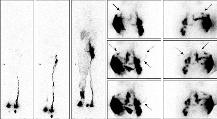 Diagnostic lymphoscintigraphic images of a 65-year-old male with secondary right lower limb lymphedema (LLLE) following inguinal node dissection for Merkel cell carcinoma. The panel includes three consecutive whole-body scans (WBS) and static pelvic images. Phase 1 (rest) shows normal tracer drainage to the left inguinal lymph node, while the right side displays delayed outflow. Phase 2 (active movement) demonstrates increased activity in the left inguinal region and limited distal drainage on the right. Phase 3 (post-walking) reveals significant pathological findings on the right, including dermal backflow at the foot and ankle, and a superficial collateral network extending proximally toward visible inguinal and iliac nodes. Detailed pelvic views (anterior and posterior) show collateral lymphatic drainage vessels (LVs), specifically median and oblique pathways. These include LVs crossing the midline and drainage toward the contralateral (left) inguinal lymph nodes. Arrows highlight specific collateral channels and areas of midline crossover, demonstrating physiological adaptations to lymphatic obstruction.