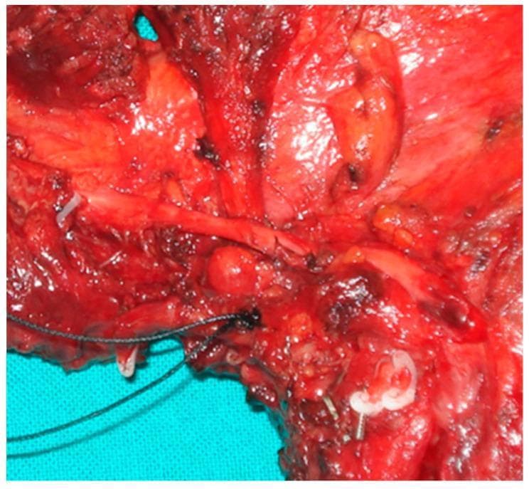 A high-magnification intraoperative clinical photograph of a surgical specimen following a compartment tongue resection for oncology. The image displays the macroscopic anatomy of the T-N (Tumor-Node) tract, focusing on the metastasis of lingual lymph nodes. The surgical field is predominantly characterized by deep red, striated muscle tissue, likely representing the extrinsic tongue muscles (hyoglossus and genioglossus). Central to the image is a discrete, rounded, firm mass representing a metastatic lingual lymph node, positioned along the lymphatic drainage pathway. Linear, pale structures indicative of neurovascular bundles or large-caliber nerves (greater than 1 mm) are visible traversing the field, potentially serving as conduits for perineural neoplastic progression. Surgical artifacts including black silk sutures and metallic hemoclips are present, marking key anatomical landmarks or ligated vessels. The tissue exhibits varied textures from smooth vascular sheaths to irregular, congested areas suspicious for neoplastic infiltration or 'in transit' lymphatic metastasis. This visual serves to educate on the anatomical pathways of oral cancer spread and the principles of compartmental surgery.