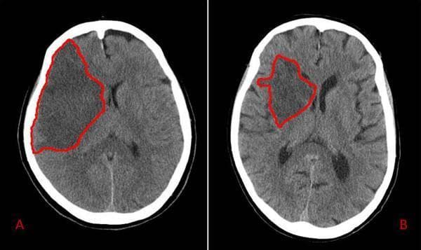 This diagnostic image displays two side-by-side axial non-contrast CT scans of the brain, labeled A and B, illustrating varying extents of ischemic stroke in the right middle cerebral artery (MCA) territory. In both panels, the infarcted areas are demarcated by red outlines. Panel A demonstrates a large, confluent hypodense region involving the right frontal and temporal lobes, extending to the cortical surface, consistent with a total MCA occlusion. There is a visible mass effect characterized by effacement of the right lateral ventricle and a subtle midline shift to the left. Panel B shows a smaller, more localized hypodensity primarily affecting the deeper parenchyma and subcortical structures of the right hemisphere, sparing the peripheral cortex, typical of a partial MCA territory infarct. In panel B, the ventricular system and midline structures remain relatively preserved compared to panel A. This comparison highlights the radiological presentation of different stroke severities and their secondary effects on brain morphology 48 hours post-admission.
